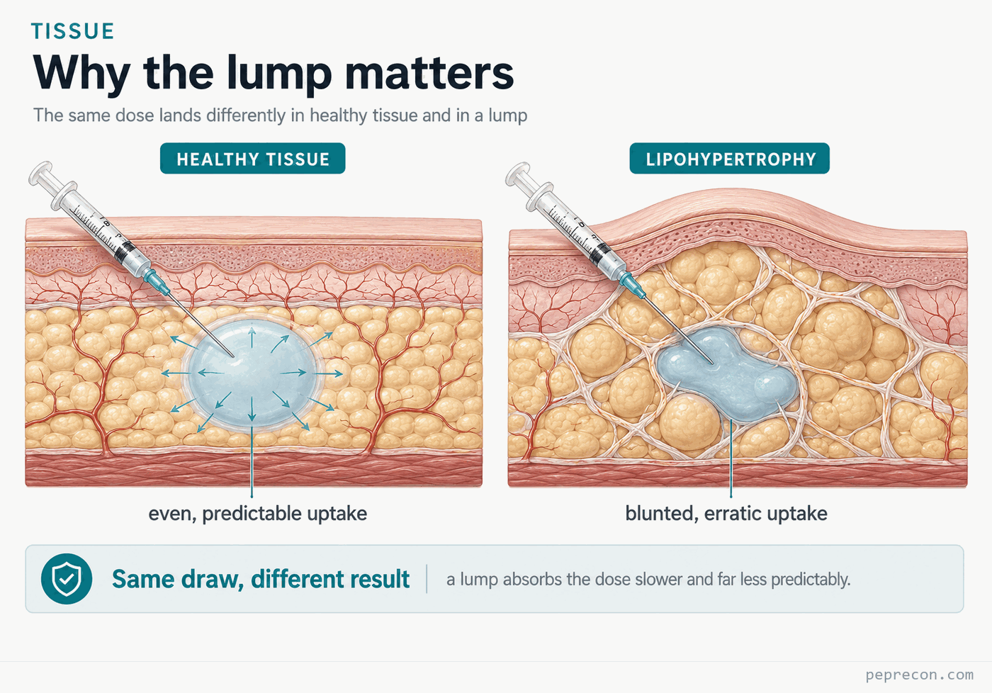 Infographic, Why the lump matters: two skin cross-sections compared. In healthy subcutaneous tissue an injected depot disperses evenly for predictable uptake; in lipohypertrophy the tissue is fibrous and lumpy and the same depot pools unevenly for blunted, erratic uptake. The same draw absorbs slower and far less predictably in a lump.